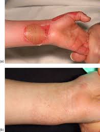 Dermal preservation using the Versajet® hydrosurgery system for debridement  of paediatric burns - ScienceDirect