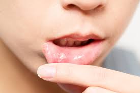 mouth ulcer cirocco dental