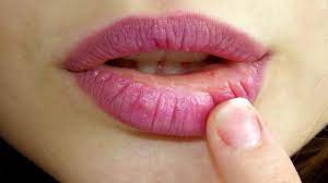 kissing helped spread herpes