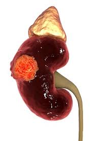 Renal Tumor Size Influences Its Aggressiveness Renal And
