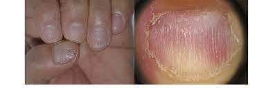 nail fragility due to alopecia areata