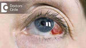 causes of red clots in eyes dr mala