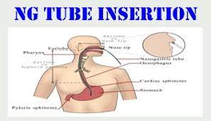 fine bore ng insertion for nmc