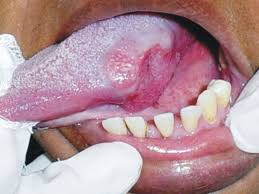 ulcerative lesions of the mouth an