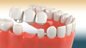 dental crowns and bridges fillings
