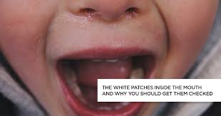the white patches inside the mouth and