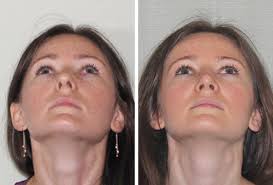 However, it may be another symptom of something more serious, such as marfan's. Before And After Nasal Surgery Photos Dr Garrett Bennett Ny Sinus Rhinoplasty Surgeon