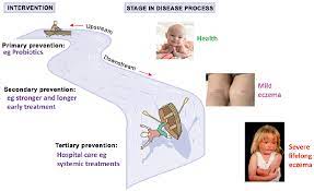 prevention of atopic dermais html