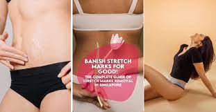 stretch marks removal in singapore the