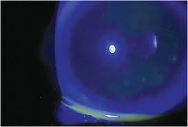 Optometric Management Cornea Don T
