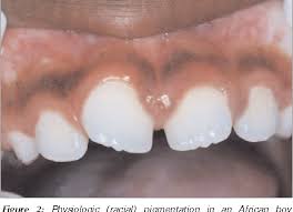 Figure 2 from Pigmented lesions of the oral cavity: review, differential  diagnosis, and case presentations. | Semantic Scholar