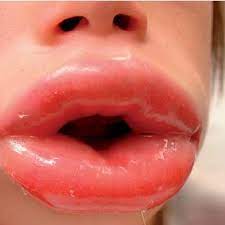 photograph of peri and lip swelling