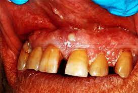 infection in your mouth can result in