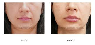 lip lift augmentation by dr sophie