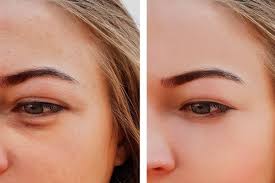 how to treat under eye puffiness at