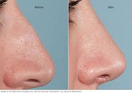 Some people also get plastic surgery on their nose, to change its shape, at. Deviated Septum Diagnosis And Treatment Mayo Clinic