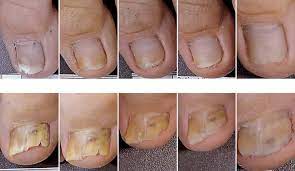 onychomycosis affected nail