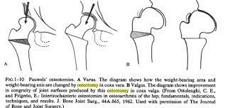 proximal fem osteotomy bone and spine