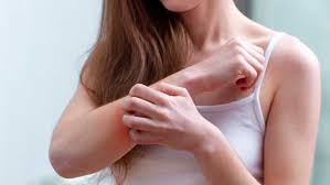 Image result for psoriasis symptoms images