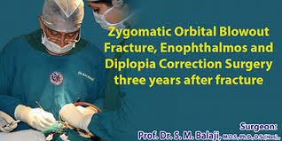 zygomatic orbital out fracture