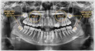 swollen wisdom tooth gum causes signs