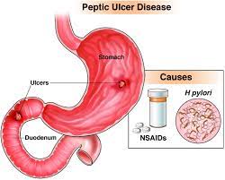 Peptic ulcer disease - AGA GI Patient Center