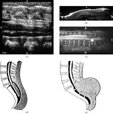 a sagittal spinal ultrasound showing