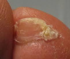 pinky toenail split