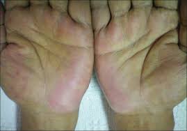 Primary palmar erythema or physiologic palmar erythema is classified as: View Image