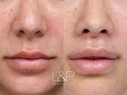 corner lip lift treatment