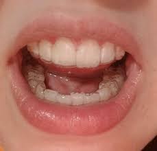 Jacquie smiles specializes in gapped teeth treatment with invisalign clear braces in nyc. Gap Between Tooth And Bottom Of Invisilign That Can T Be Moved Because Of The Other Tooth Should I Address This With My Dentist Or Is It That Big Of A Deal I