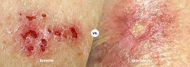 skin cancer eczema or skin cancer