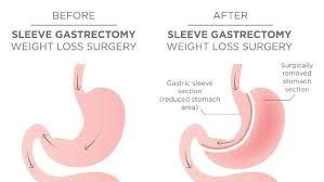 what is gastric sleeve surgery