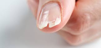 brittle nails causes and how to care