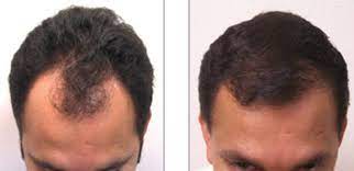 hair transplant cost kurtzman plastic