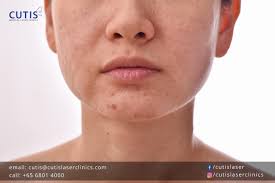 got acne e skin be sure to avoid