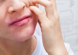 eczema on lips symptoms triggers