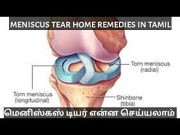 meniscus tear home remes in tamil