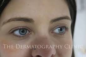 permanent eyeliner the dermatography