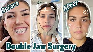 jaw surgery recovery vlog