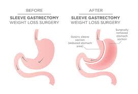 sleeve gastrectomy doctor for sleeve