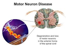 motor neuron disease mnd dr matty
