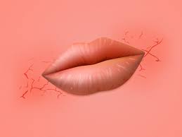 what is angular cheilitis the painful