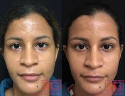 tca cross acne scars procedure