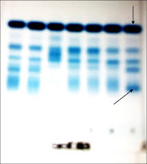 serum protein electroptic patterns