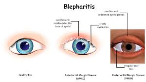 diy eyelid scrub for blepharitis