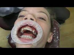 Recommended 0 times recommend this. Watch How We Put Your Braces On Youtube