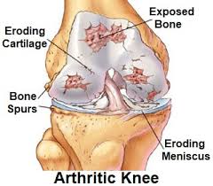 Knee Arthritis Treatment Knee Pain Explained