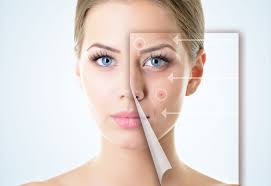 Image result for Acne Treatment