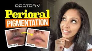 treating hyperpigmentation around mouth